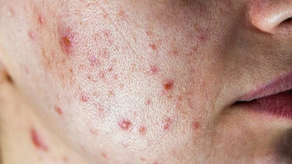 Perimenopause Acne ccan happen to women as the menstral cycle becomes unpredictable.